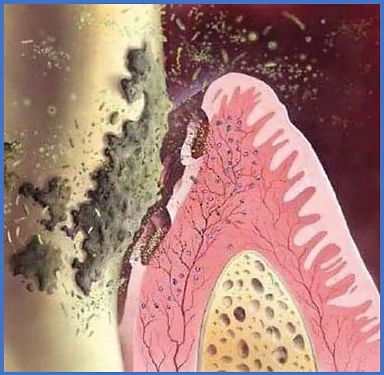 Płytka nazębna w okolicy szyjki zębowej