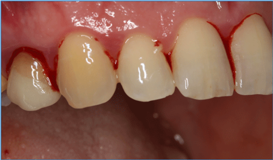 Krwawiące dziąsła