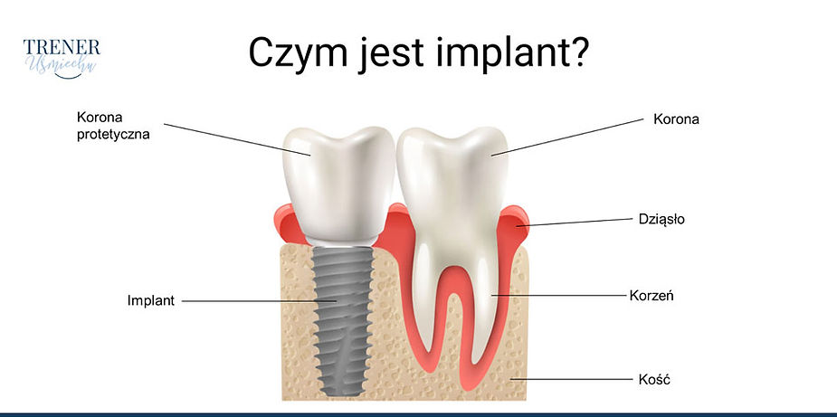 czym jest implant