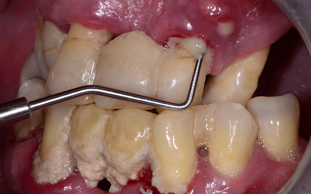 sonda periodontologiczna badanie dziąseł zapalenie dziąseł przyzębie