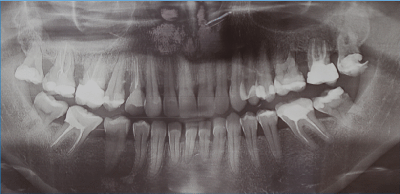 Zdjęcie radiologiczne pacjenta - gabinet stomatologiczny
