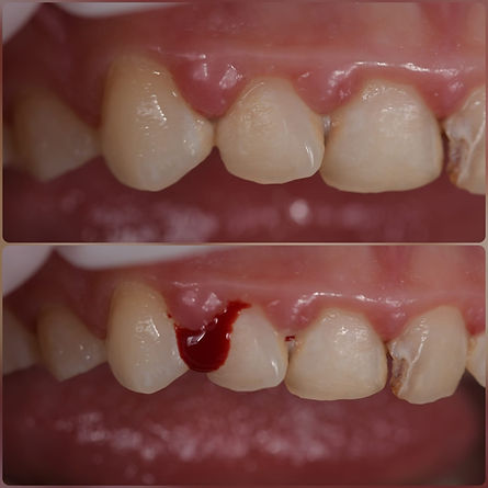 Krawienie z dziąseł