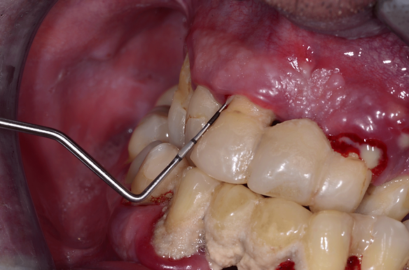 sonda periodontologiczna badanie dziąseł
