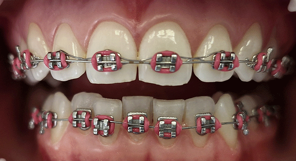 Leczenie aparami ortodontycznymi