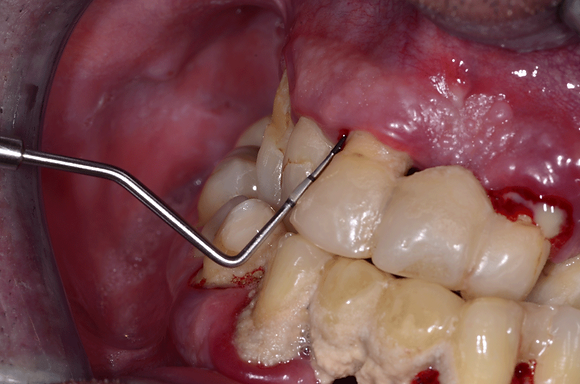sonda periodontologiczna badanie dziąseł zapalenie dziąseł